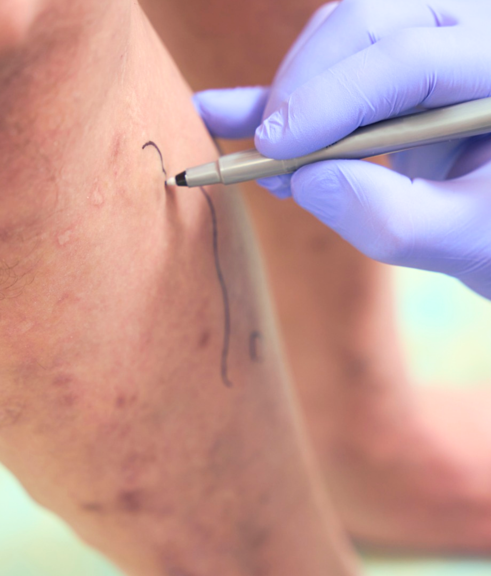 Angiologista e Cirurgiã Vascular em Conselheiro Lafaiete e em Congonhas | Especialista no Tratamento de Varizes e no Tratamento de Lipedema