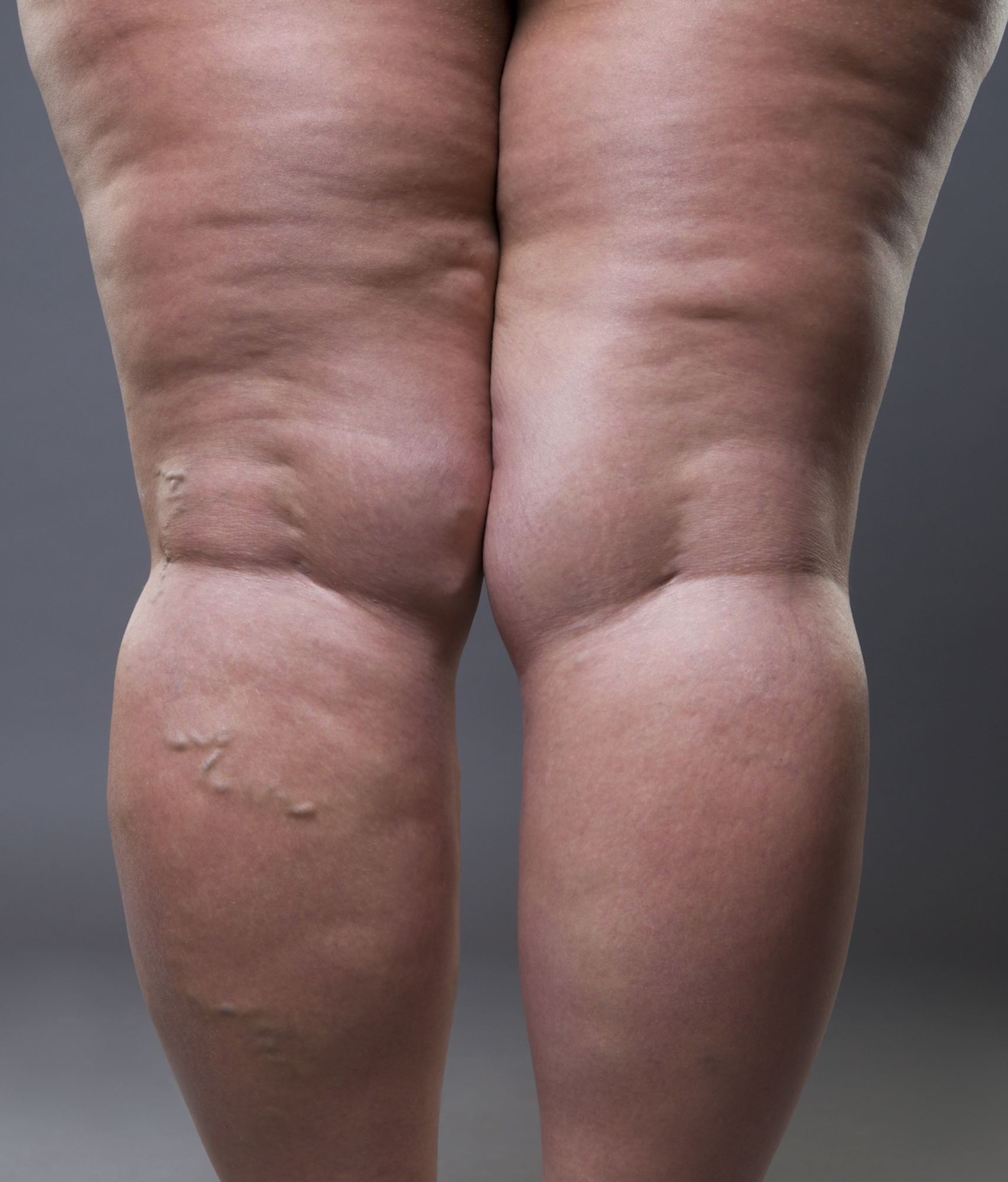 Angiologista e Cirurgiã Vascular em Conselheiro Lafaiete e em Congonhas | Especialista no Tratamento de Varizes e no Tratamento de Lipedema