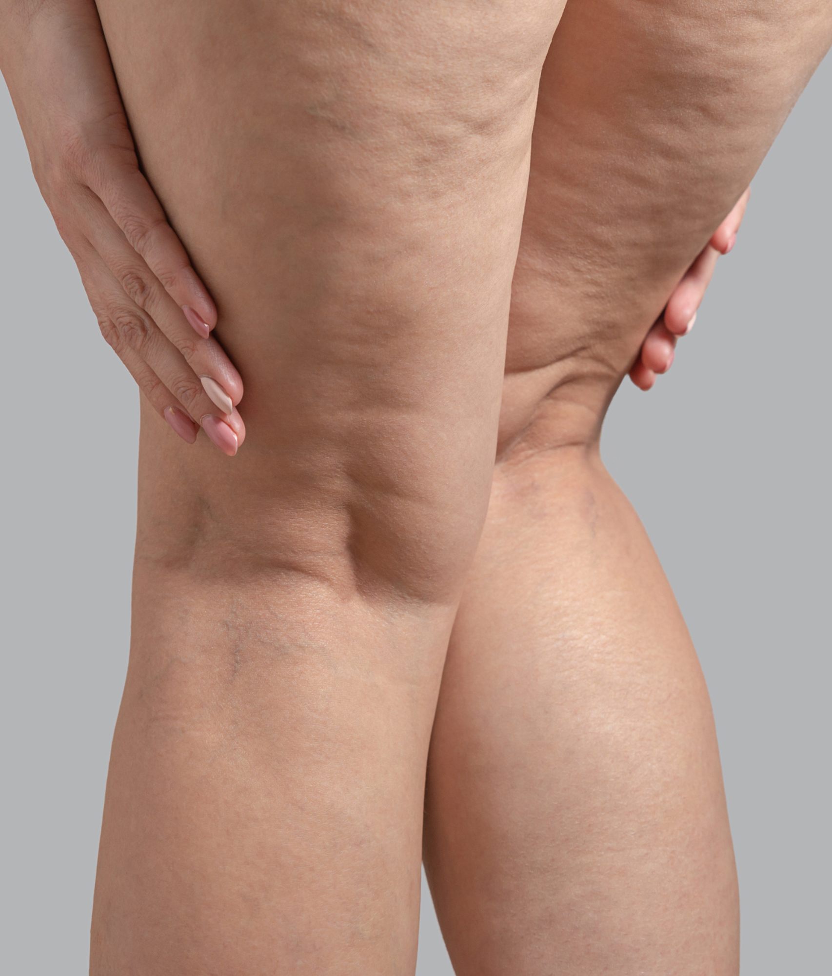 Angiologista e Cirurgiã Vascular em Conselheiro Lafaiete e em Congonhas | Especialista no Tratamento de Varizes e no Tratamento de Lipedema